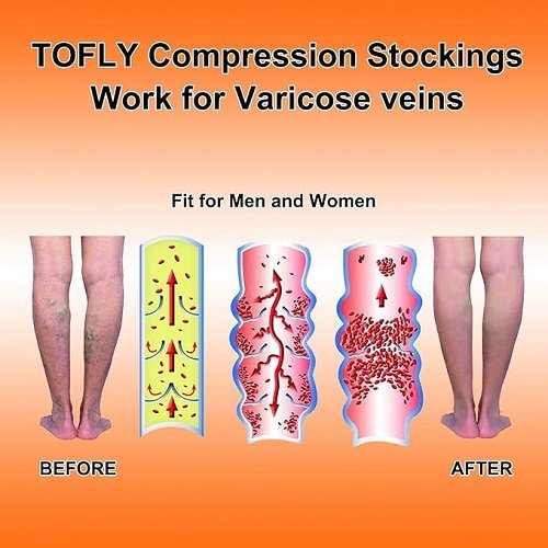 Compression Stockings (Pair), Grade Firm Support 20-30mmHg, Opaque, Unisex, Open Toe Knee High Compression Socks for Varicose Veins, Edema, Shin Splints, Nursing, Travel, Beige XL